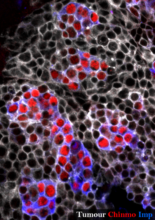 Neural stem cell tumour in the Drosophila adult central nervous system stained for GFP (grey), Chinmo (red) and Imp (blue). The tumour is composed of an heterogenous cell population.